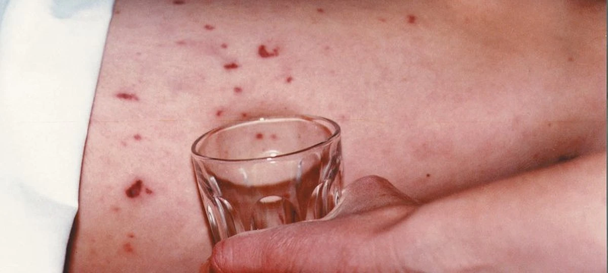 Proč se v nočních klubech častěji mluví o sdílení vapes a jedné konkrétní bakterii - image 1