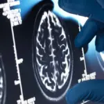 Proč nové drahé léky na Alzheimera v praxi selhávají