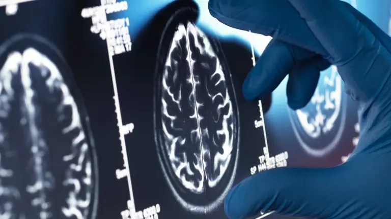 Proč nové drahé léky na Alzheimera v praxi selhávají