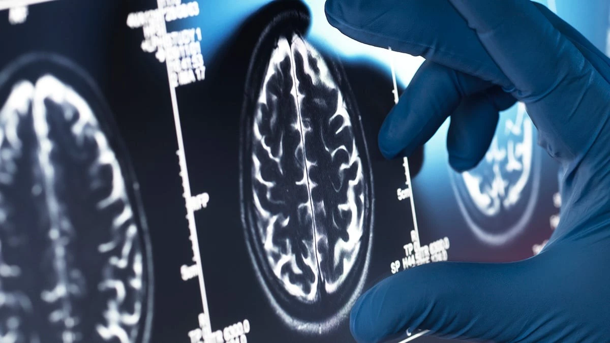 Proč nové drahé léky na Alzheimera v praxi selhávají