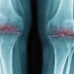 Proč zkušení lékaři začínají mluvit o konci éry umělých kolen díky blokování jednoho proteinu