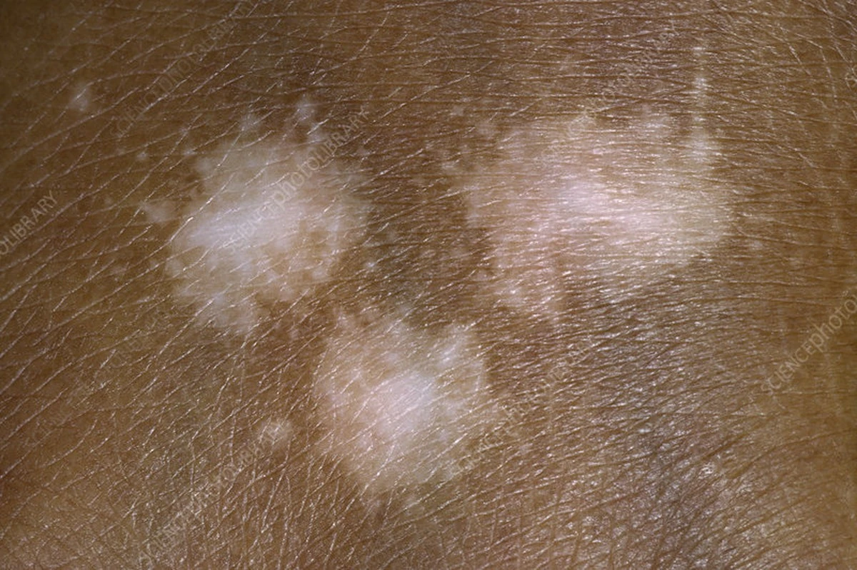 Proč se tělo zbavuje vlastní barvy: Skutečný důvod vzniku bílých skvrn na kůži - image 1