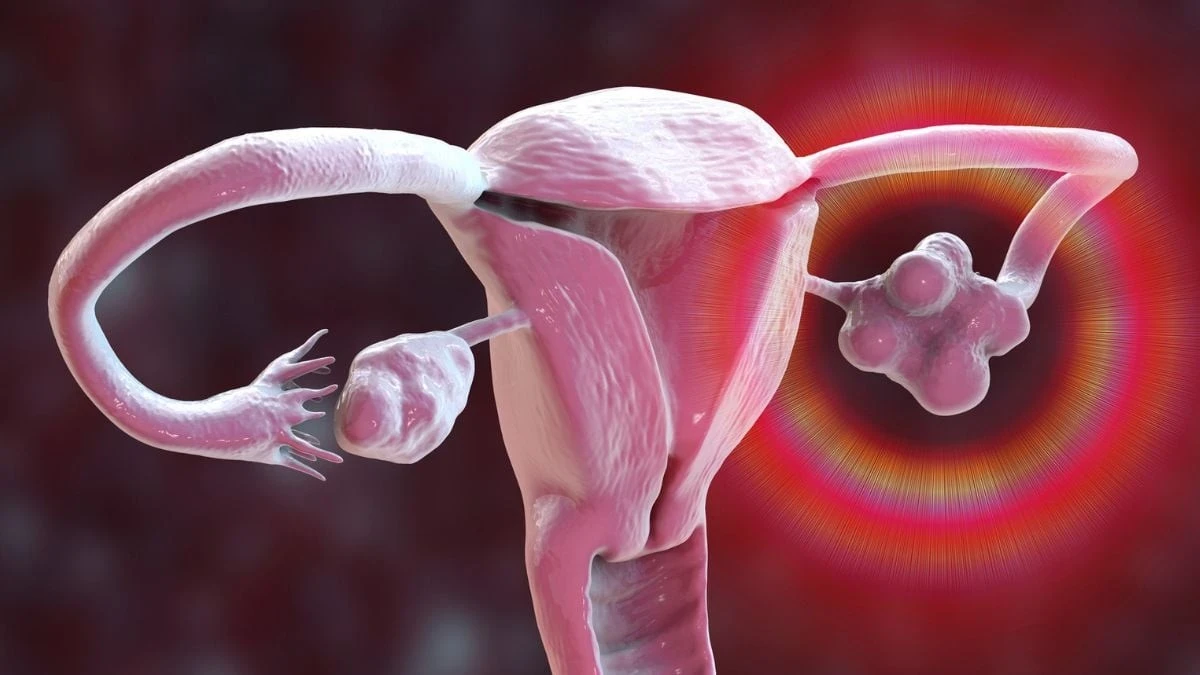 Proč se už diagnóza PCOS nebude používat: Lékaři v Praze oznámili zásadní změnu