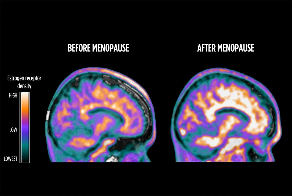 Proč úbytek estrogenu v mozku vysvětluje riziko Alzheimera u žen - image 1