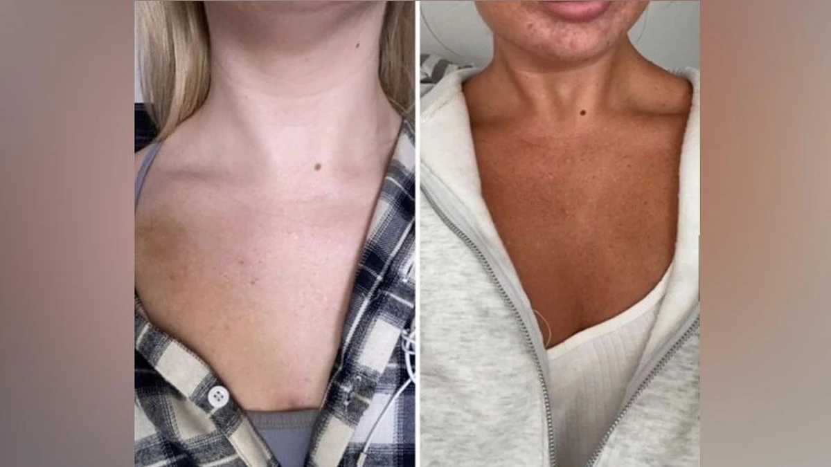 Hazard se zdravím kvůli hnědé kůži: Proč dermatologové varují před lahvičkami z TikToku - image 1