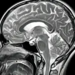 Proč léky na Alzheimera selhávají: V hloubi mozku se zastaví o nečekanou bariéru