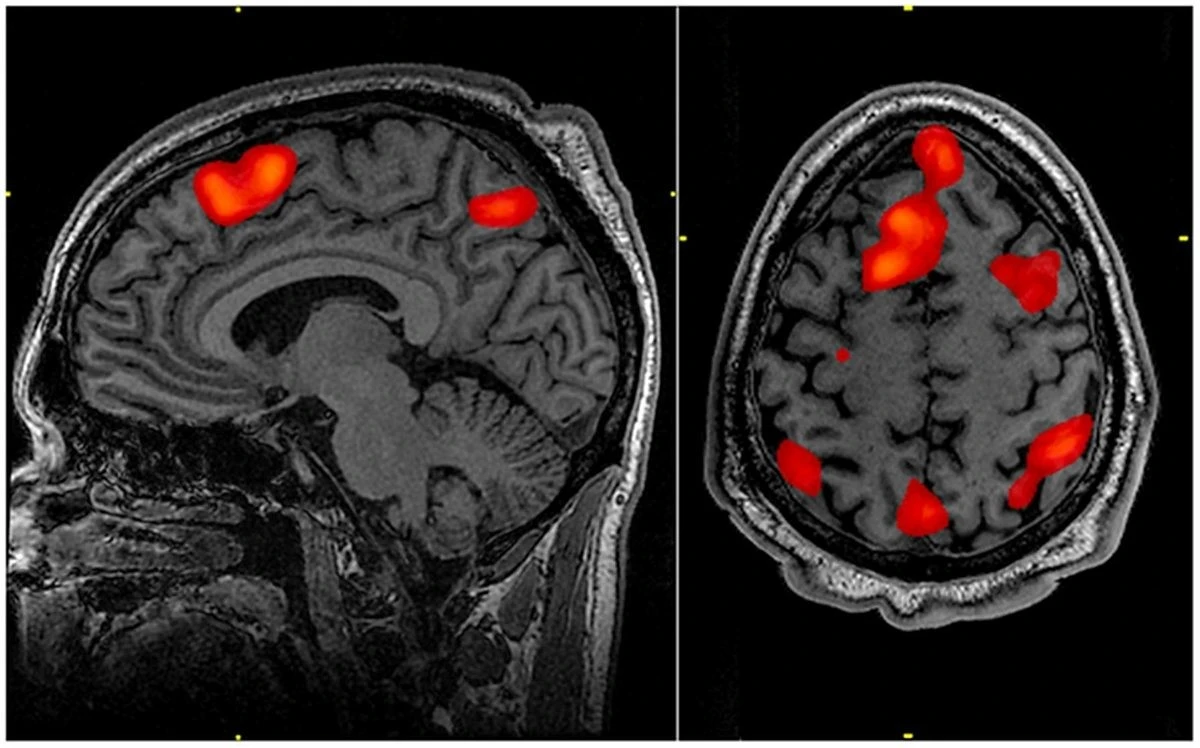 Proč léky na Alzheimera selhávají: V hloubi mozku se zastaví o nečekanou bariéru - image 1