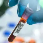 Proč se anorexie vrací: Vědci našli v krvi hormonální brzdu, která vypíná hlad