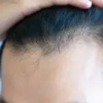 Proč se po populární injekci na hubnutí mění kvalita vlasů