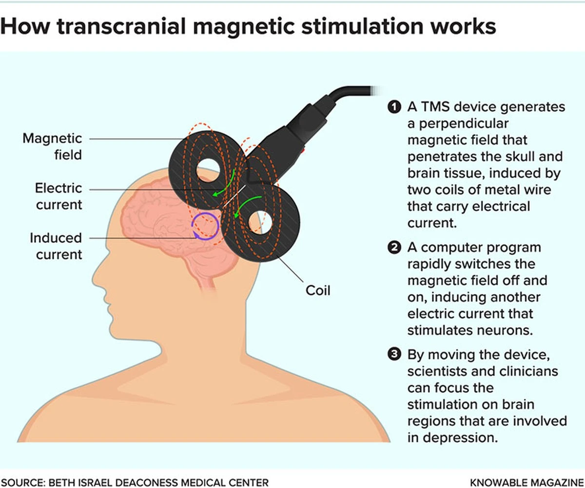 Proč vědci přikládají lidem s depresí magnetickou cívku k hlavě - image 1