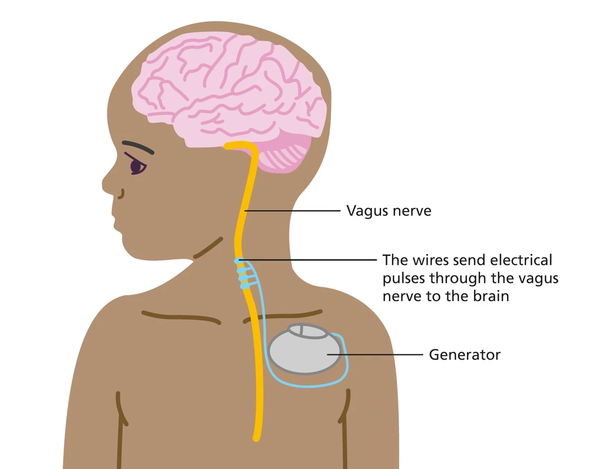 Proč zkušení psychiatři začali vkládat malý kardiostimulátor pod kůži na krku - image 1